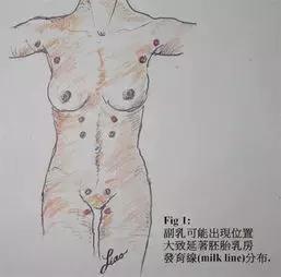 什么是副乳？副乳的危害有那些？