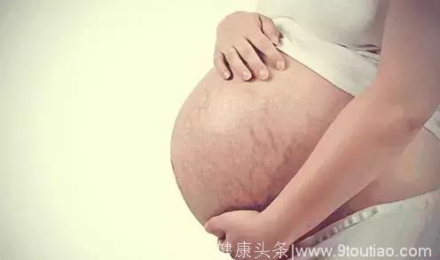正确预防妊娠纹，孕育可以不留痕！
