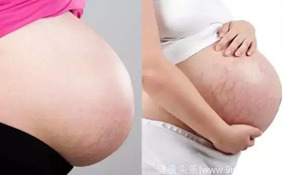 正确预防妊娠纹，孕育可以不留痕！