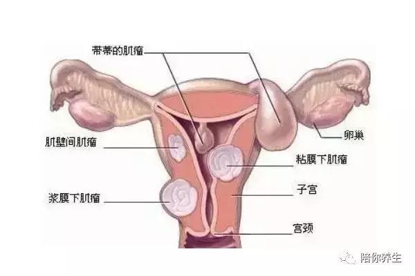 子宫肌瘤是怎么回事？教你一招