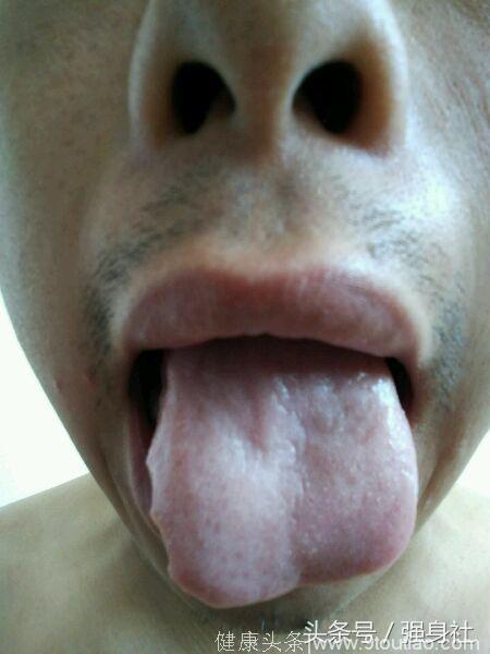舌诊：肝脾不和、脾胃虚寒、肝脾不调、血虚肝郁的舌苔照！