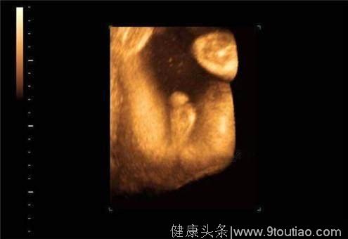 明明检查出了是男宝宝，生出来的确实女的，则是咋回事？