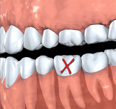 一颗牙齿掉了，你知道其他牙齿在干什么吗？