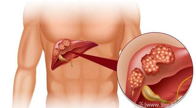 40岁女子从来不喝酒，发现肝癌4个月后离世，医生说2件事害了她！