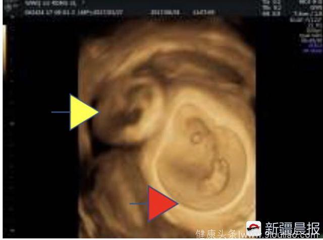29岁女子怀二胎宫外孕引众人共鸣 专家：宫外孕真的需要大家重视