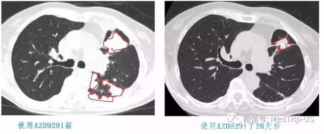 肺癌怎么选择靶向药（中）