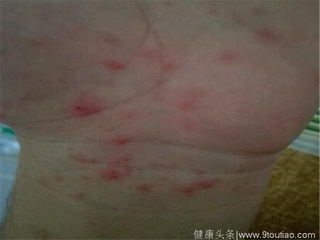 六年湿疹六年痛，一个农村方法，不再受到湿疹困扰