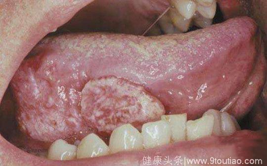 长期牙磨损可导致舌癌，槟榔竟然是诱因之一
