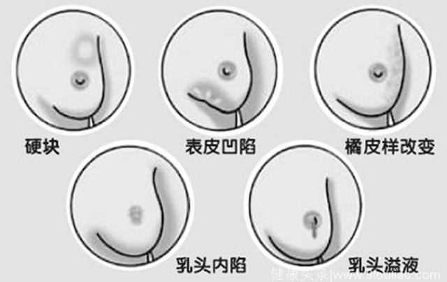 乳腺癌早期的6个症状，常吃1种东西可预防