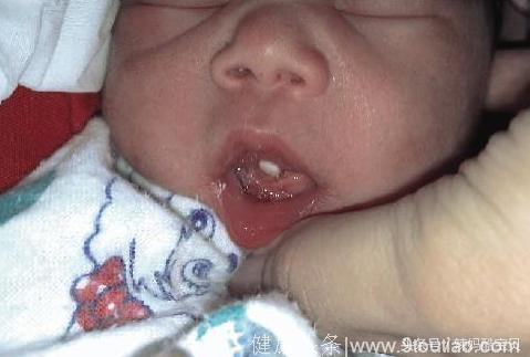 稀奇！婴儿出生后一直大哭不止，医生掰开嘴一看吃了一惊！