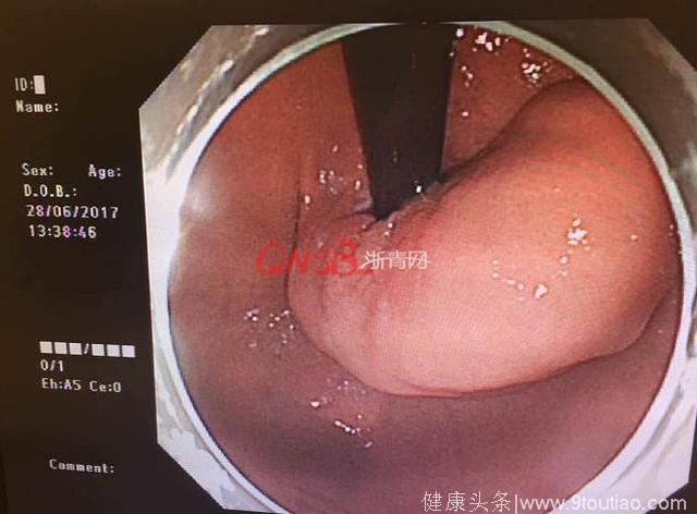 杭州女白领总觉得喉咙有异物，医生从她嘴里拖出12厘米长肿瘤！