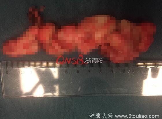 杭州女白领总觉得喉咙有异物，医生从她嘴里拖出12厘米长肿瘤！