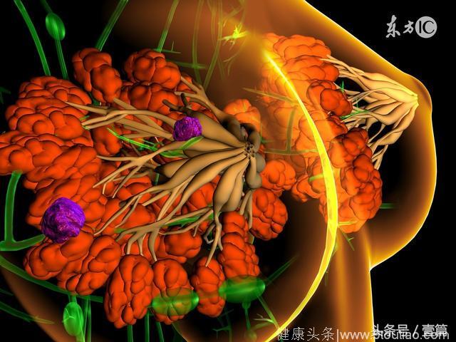 美国《临床肿瘤杂志》：罗氏新药T-DM1可替代乳腺癌新辅助化疗