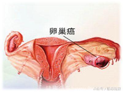 子宫内膜异位症引起卵巢癌，肾脏和甲状腺癌的风险