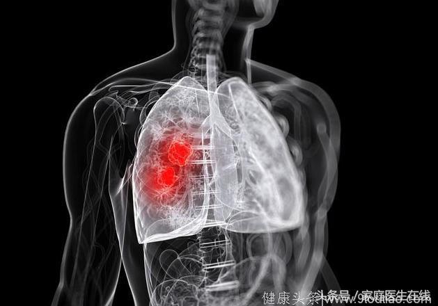 肿瘤专家林丽珠：不想得肺癌谨记这一点，大多数人却做不到