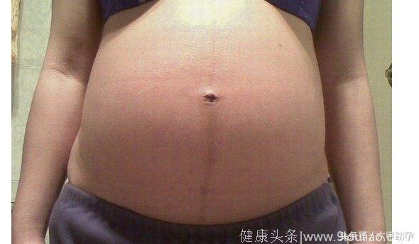 进击的孕妇：孕期的妊娠纹可以避免吗？可以部分阻止的妊娠纹