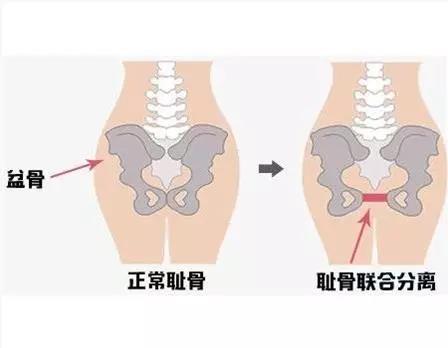 多喜娃：孕期大腿中间隐隐作痛，可能是耻骨分离！