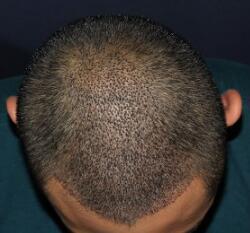 北京无痕植发价格23800元不怕秃顶，植发过程多图对比分享