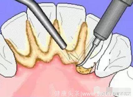 什么是牙结石？怎样去除牙结石，配合正确的刷牙方法！