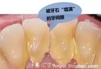 北大口腔博士王玉玮解惑：牙医，为什么总让你洗牙？