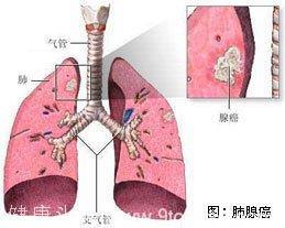 83版《射雕》“黄蓉”因肺腺癌去世，7大肺腺癌常见症状必须要警惕