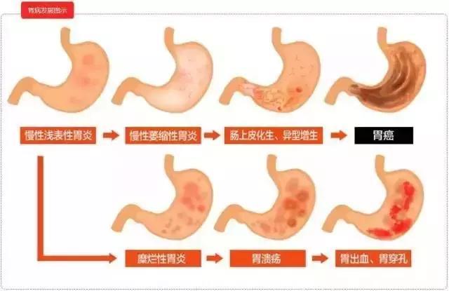 日本高胃癌治愈率给我们的启示