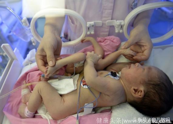 新生儿出生多了两只手两只脚，男婴父亲狠心说如果产检B超发现，就不会考虑生下来