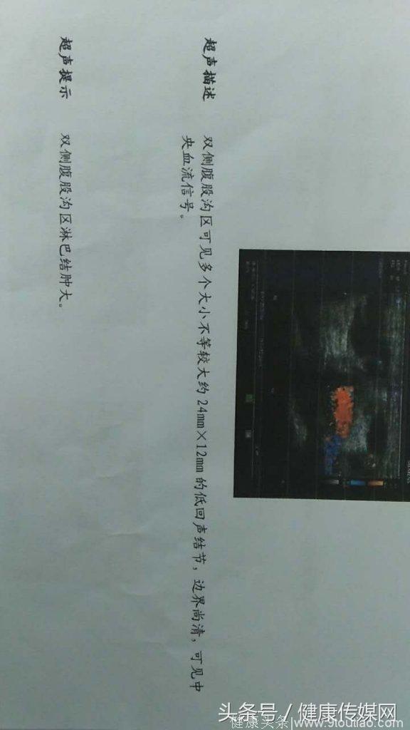 汉阴县人民医院普外二科为一阴茎癌患者精准诊治