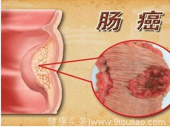 手指可以检查身体有没有癌症，身体发出的五大信号要注意