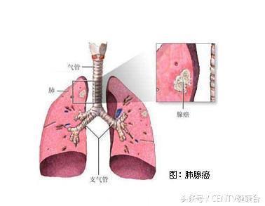 83版“黄蓉”去世，从发现到过世仅3个月，什么癌症这么可怕？