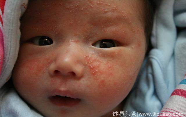 杭州一男孩第一次吃小龙虾结果诱发哮喘，那些被你忽视的过敏食物