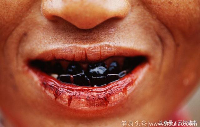 中年男子每天一包槟榔患舌癌，舌头切掉一半用大腿肉补上，苦不堪言！