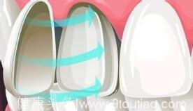 深圳麦芽口腔知识分享：牙齿颜色不好看是不是都可以做牙齿贴面？