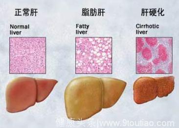 专家提醒：脂肪肝不容被忽视，严重可致肝硬化！