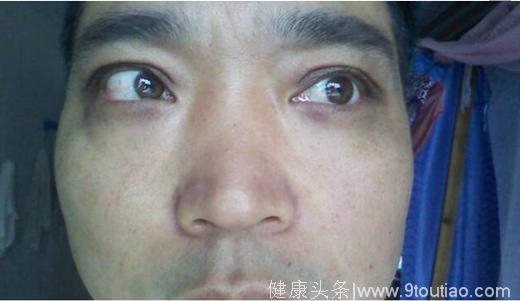 不要小看黑眼圈，这种“熊猫眼”很可能提示肝硬化进入晚期