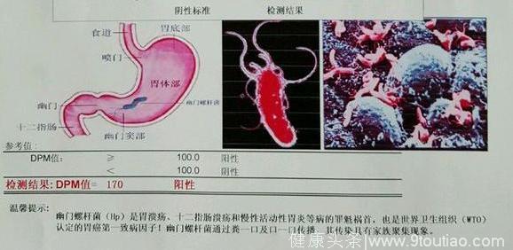 幽门螺旋杆菌阳性会变胃癌？很多人都错了，是可以根除的