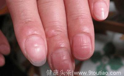 手指甲出现了黑线，不要忽视，可能是癌症早期的信号