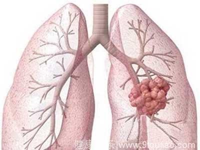 “医生告诫：四个信号提示你，“肺炎”即将变“肺癌”，及时戒烟，可保命！”