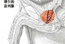 前列腺结石的诊断治疗方法