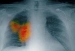 专家介绍诊断肺癌的三大手段