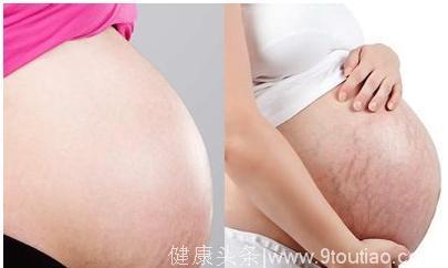 妊娠纹真的很会挑人，看看你是不是那种容易出现妊娠纹的孕妈？