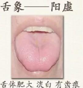 收藏！舌头看健康，这11种舌象各自代表的疾病，你都知道吗？