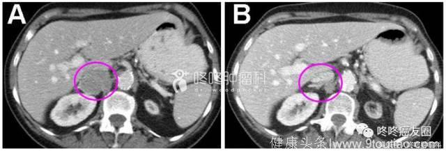 专治不服！全新抗癌药IMMU132继续挑战难治肺癌，控制率56%！