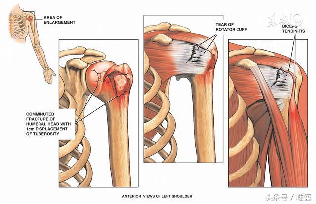肩膀疼痛十问十答：揭秘肩关节运动损伤常见问题