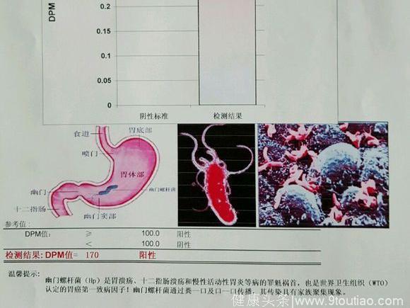 幽门螺旋杆菌，绝大部分人都有，一级致癌原，导致胃癌的根本原因，快看你中招没