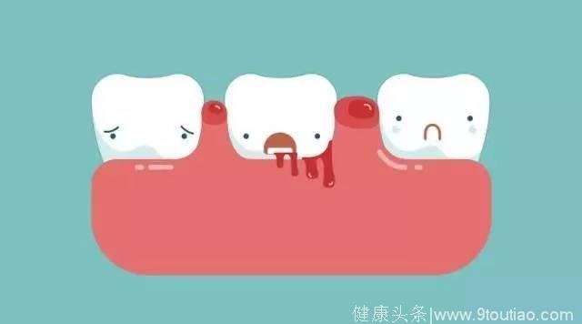 警惕：为什么牙龈总是出血？严重可导致牙齿脱落！