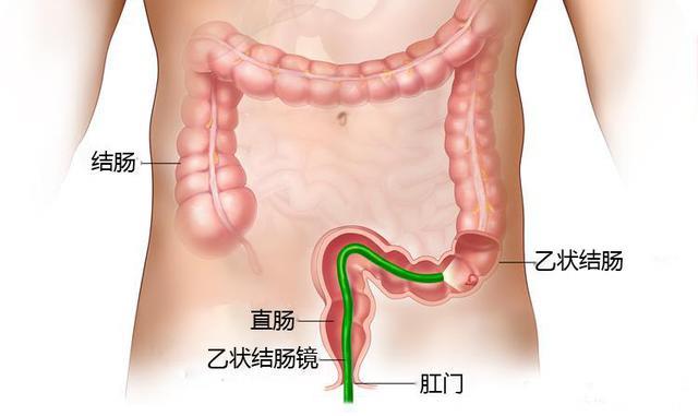 结肠直肠癌的高发病风险，看看有哪些症状？不怕看不好，就怕你不重视！