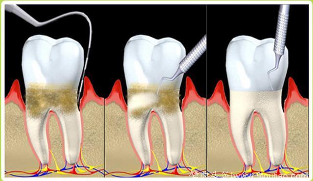 牙龈出血究竟怎么回事？原来是这3种病！