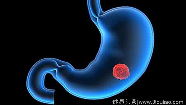 小康说药：胃癌用药替吉奥胶囊的副作用会有多重？