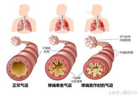 治疗支气管哮喘和慢阻肺（COPD）的新型抗嗜酸性粒细胞药物